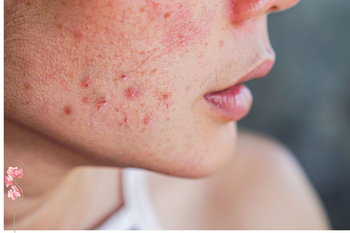 ACNE Y MENOPAUSIA