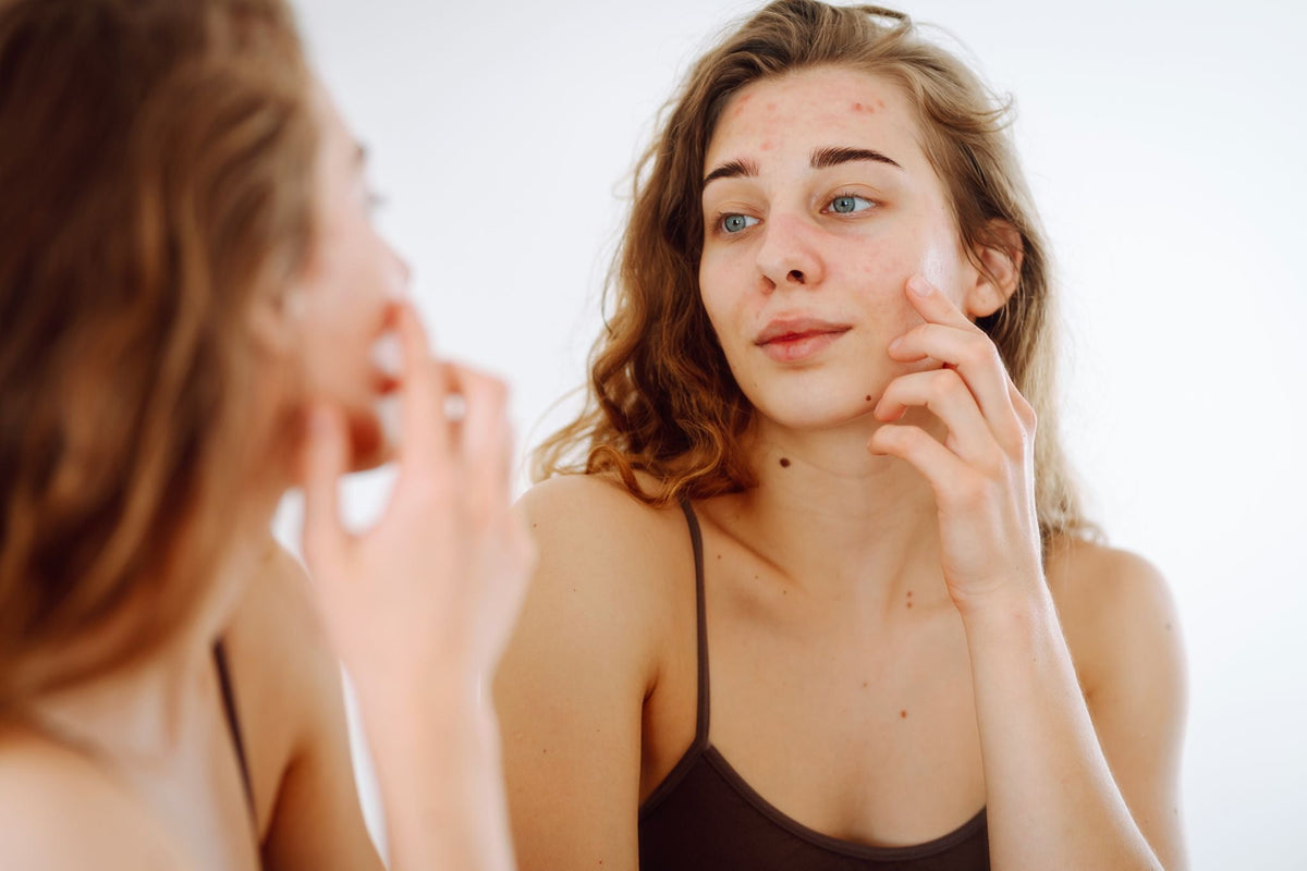¿Por qué ha aumentado el número de personas con acné más allá de la adolescencia? De la