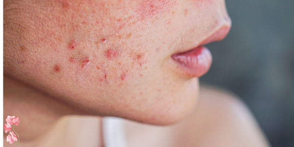 ACNE Y MENOPAUSIA